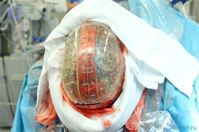 Хирурги смогли имплантировать девушке черепную коробку, изготовленную на 3D-принтере