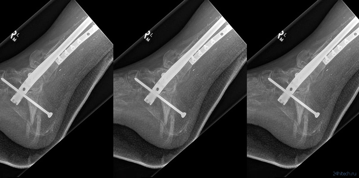 Напечатанную на 3D-принтере берцовую кость имплантировали пациенту