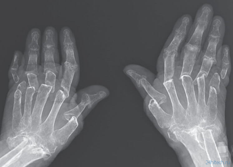 видео | Что может произойти с руками человека при осложнении артрита?