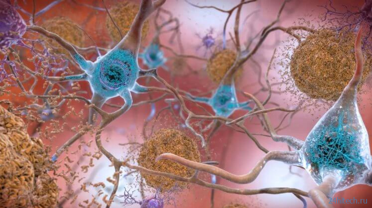 Ученые определили четыре типа болезни Альцгеймера 