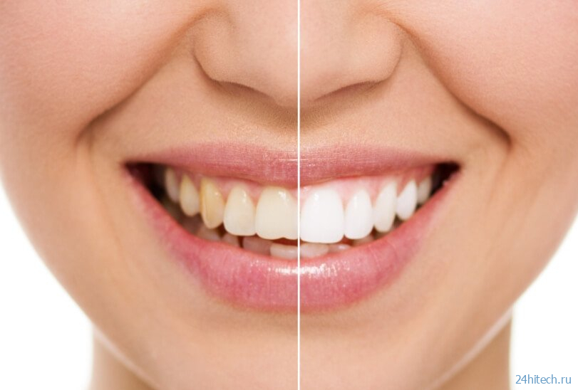 Как отбеливатели для зубов приводят к их разрушению? 