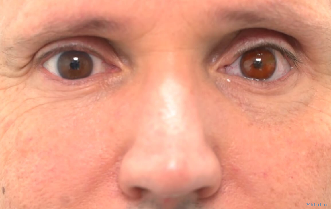 Хирурги впервые в истории вставили человеку напечатанный на 3D-принтере глаз 