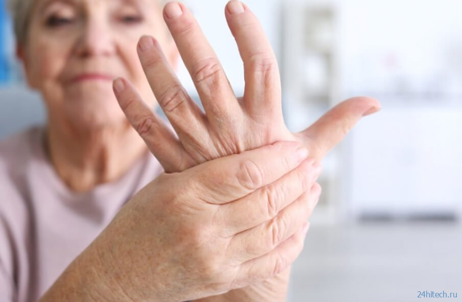 Как лекарство против артрита спасает людей от облысения?