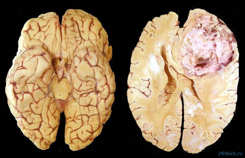 Ученые вылечили опухоль мозга за несколько дней